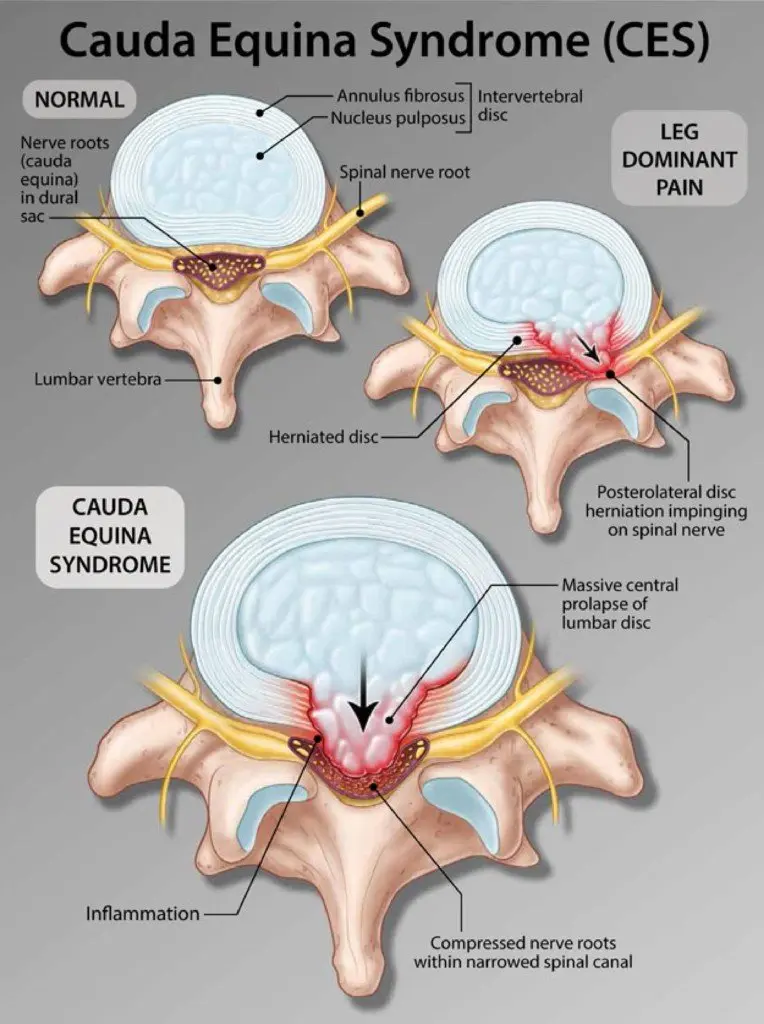 Cauda Equina Syndrome